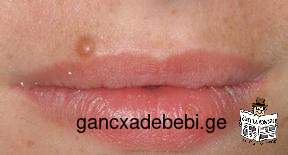 Papilloma, Skin Tag, Wart, Condylloma, Lypoma, Hemangioma etc. consulting and treatment