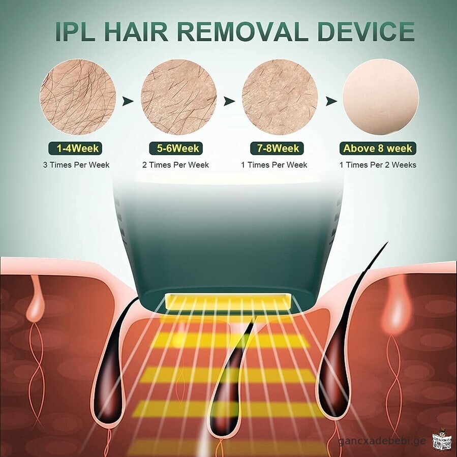 IPL laser hair removal epilators